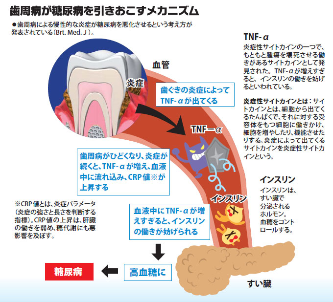 歯周病と糖尿病の関わり